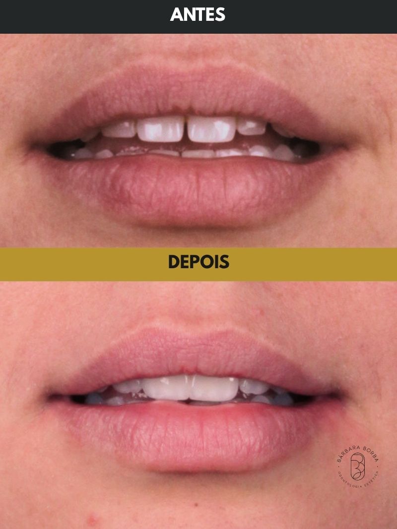Antes e depois - Case 9