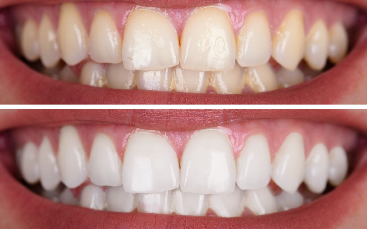 Clareamento dental - Dra. Bárbara Borba