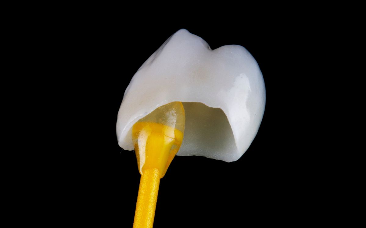 Coroas dentárias - Dra. Bárbara Borba