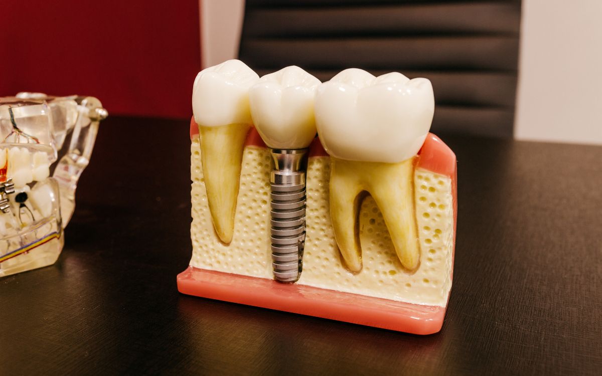 Implantes dentários - Dra. Bárbara Borba