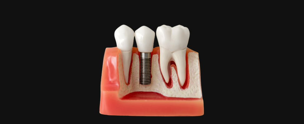 Implantes